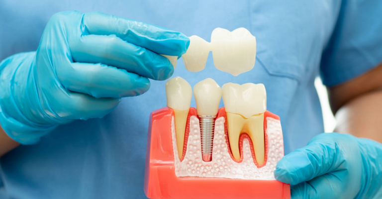 Heathmont Website Images 13 Dental Bridge Page (2) Heathmont Website Images 13 Dental Bridge Page (2)