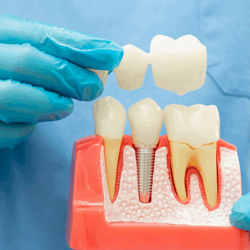 Heathmont Website Images 13 Dental Bridge Page (2)